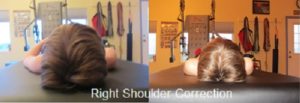 Right Shoulder Correction